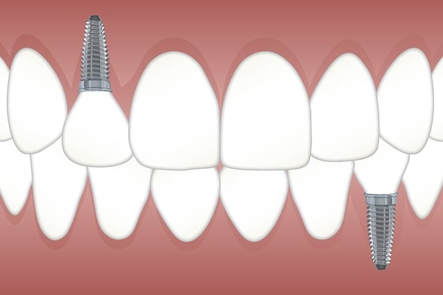 dental implants