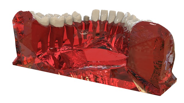 dental implants