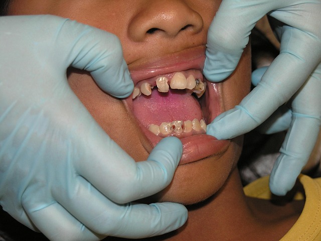 teeth whitening