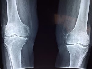 catastrophic-injuries-640x480-41673209.jpeg