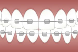 dental-bridges-640x480-74056132.jpeg