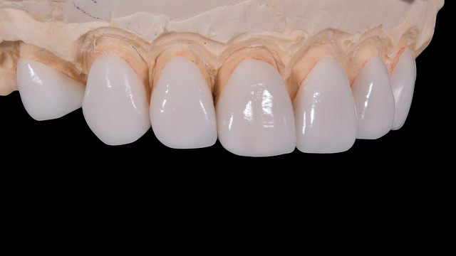 dental cleaning