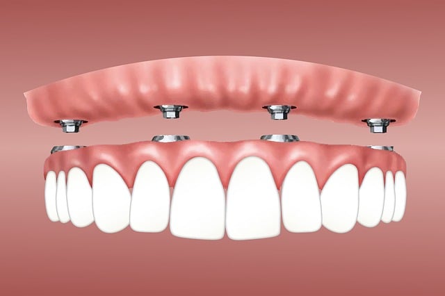 dental implants
