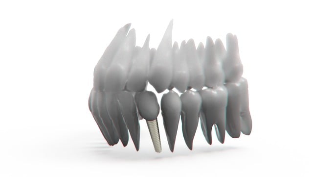 dental implants