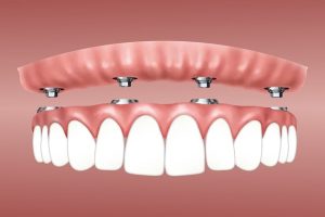 orthodontic-care-640x480-3871130.jpeg