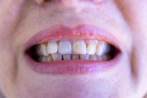 teeth-grinding-solutions-640x480-54870036.jpeg