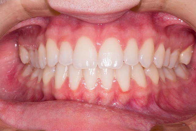 teeth whitening