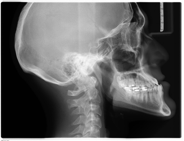 tooth bonding dentistry
