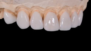 tooth-braces-640x480-46402903.png