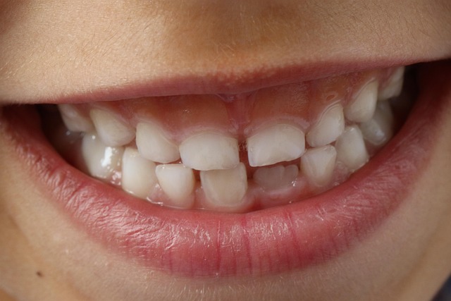 tooth braces