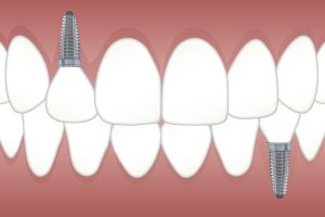 tooth-replacement-640x480-58458971.jpeg