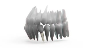 dental-implants-640x480-62128560.jpeg