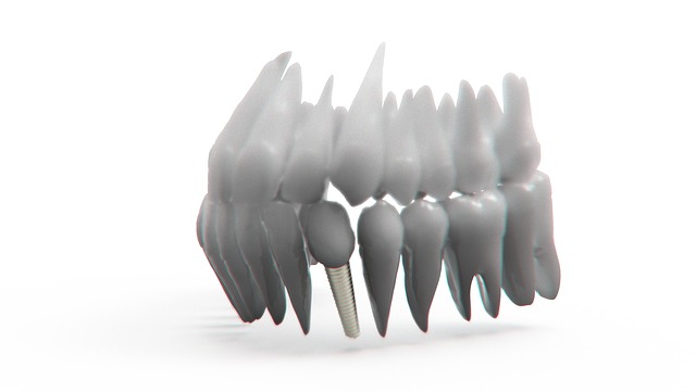 dental implants