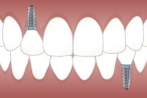 toothache-symptoms-640x480-82168537.jpeg