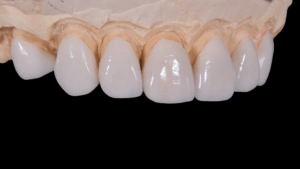 tooth-replacement-640x480-29380359.png