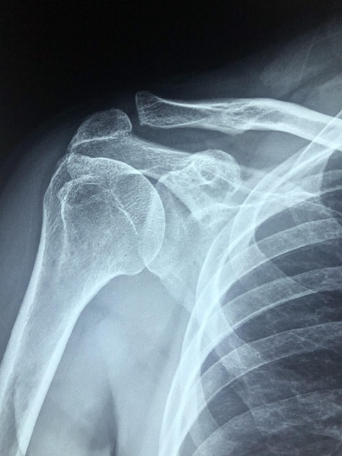 Personal Injury