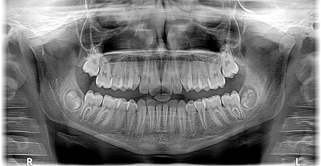 tooth-braces-640x480-76201882.jpeg