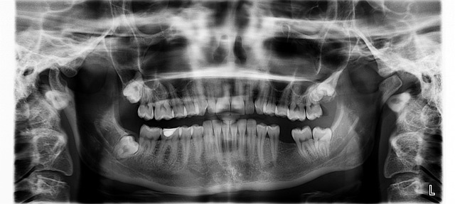 tooth extractions
