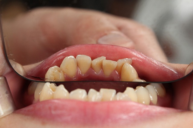 tooth extractions
