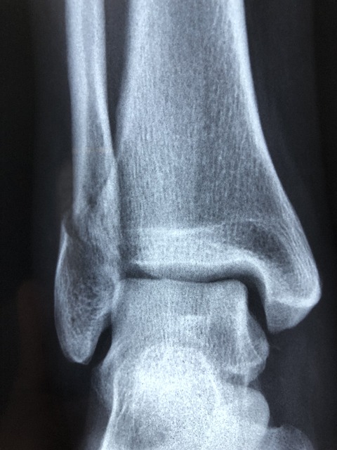 premises injury