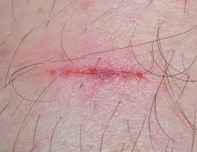 Personal Injury