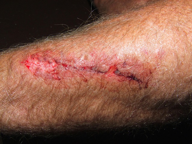 Personal Injury