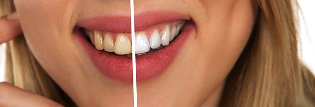 dental cleaning