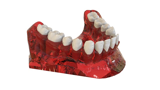 dental implants